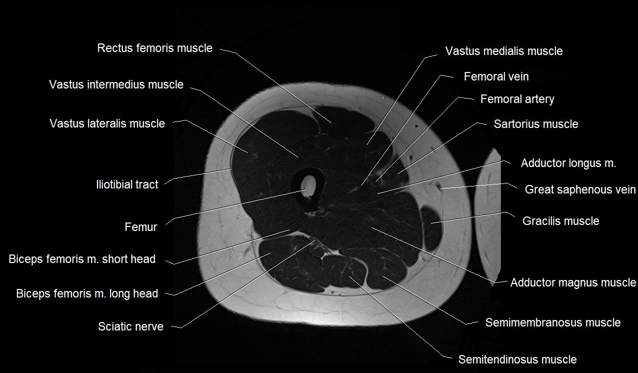 MRI thigh cross sectional anatomy image 31.webp